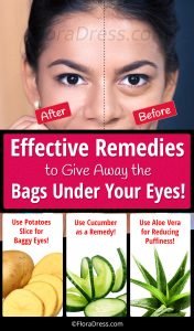 Effective Remedies to Give Away the Bags Under Your Eyes