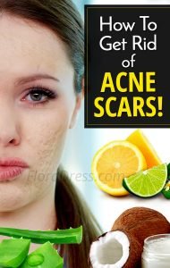 How to get rid of scars on face