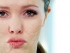 Best Effective Ways to Get Rid of Facial Scars Revealed!