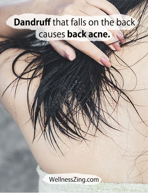 Hair Dandruff Causes Back Acne