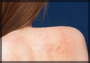 How to Treat Back Acne and Pigmentation?