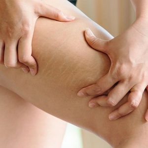Cellulite in Thighs