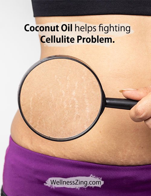 Coconut Oil Helps Fighting Cellulite Problem