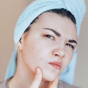 Home Remedies for Open Pores On Skin