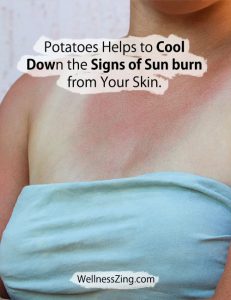 Potato Helps Cool Down Sun Burn on Skin
