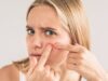Best Acne Treatment: How To Prevent Acne And Pimples?