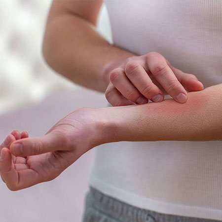 Eczema Skin Problem and Home Remedies