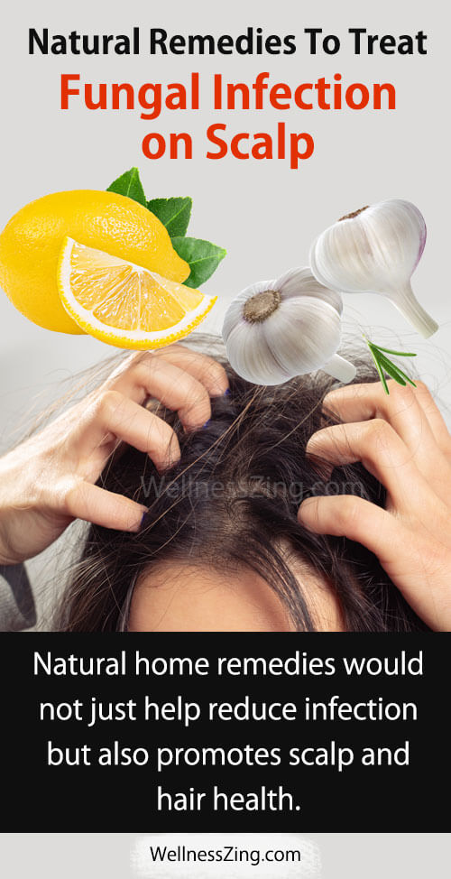 Natural Remedies for Fungal Scalp Infection