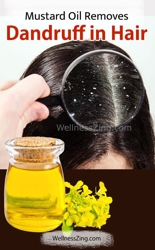 Mustard Oil Removes Dandruff in Hair