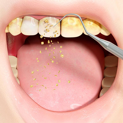 Remove Plaque and Tartar from Your Teeth