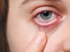 What is Pink Eye (Conjunctivitis) And Natural Ways To Treat It