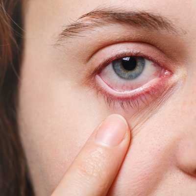 Home Remedies to Treat Pink Eye or Conjunctivitis